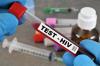 AIDS nedir, HIV testi ne zaman yapılmalı? (“Türkiye’de binlerce kişi HIV pozitif olduğundan haberdar değil”)